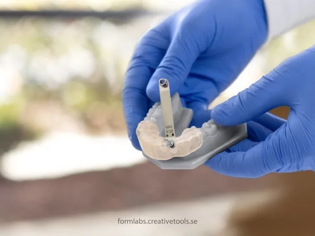 Implantációs sablon közelről, fogtechnikus kezében